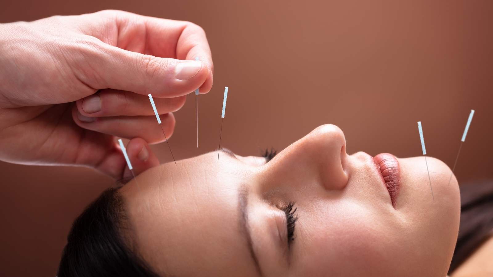 Facial acupuncture needles